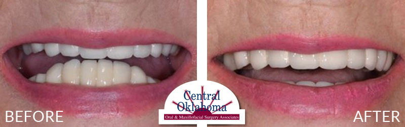 All-on-4 before and after | Oral Surgery Tulsa | Dr. Richard Miller | Central Oklahoma Oral & Maxillofacial Surgery Associates