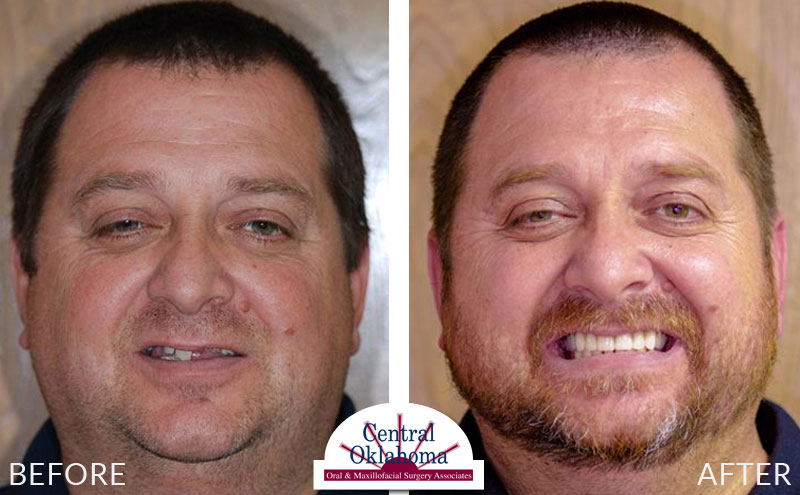 all-on-4 before and after | Oral Surgery Oklahoma City | Dr. Richard Miller | Central Oklahoma Oral & Maxillofacial Surgery Associates