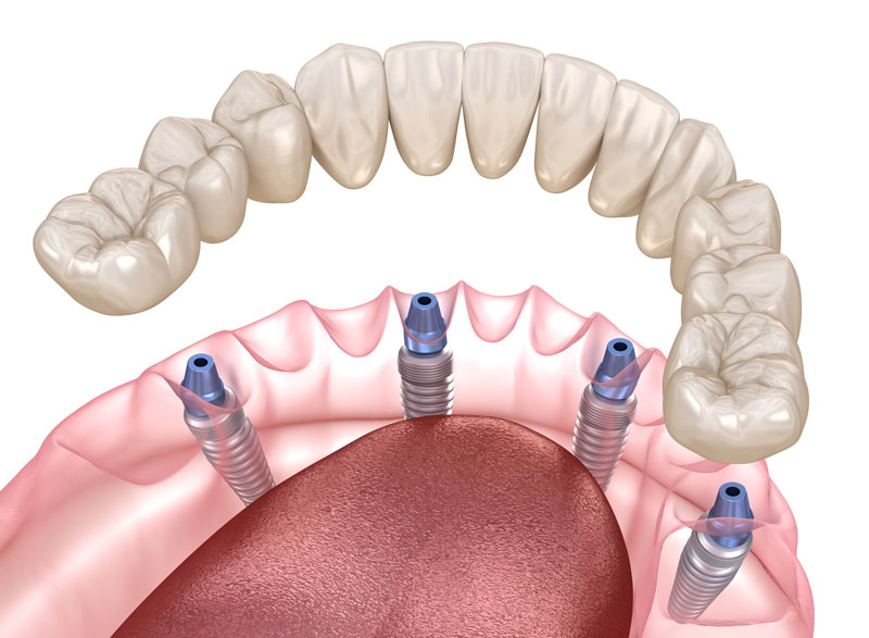 All-on-4 Teeth in a Day | Oral Surgery Oklahoma | Dr. Richard Miller | Central Oklahoma Oral & Maxillofacial Surgery Associates