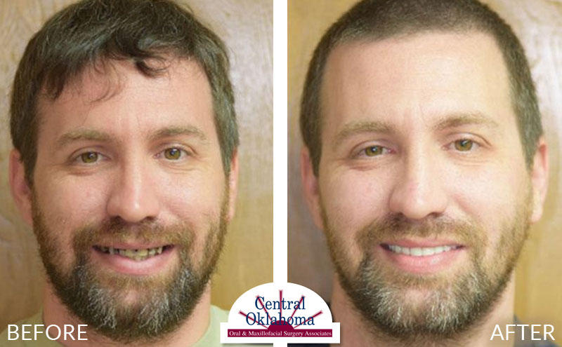 All-on-4 before and after | Oral Surgery Tulsa | Dr. Richard Miller | Central Oklahoma Oral & Maxillofacial Surgery Associates