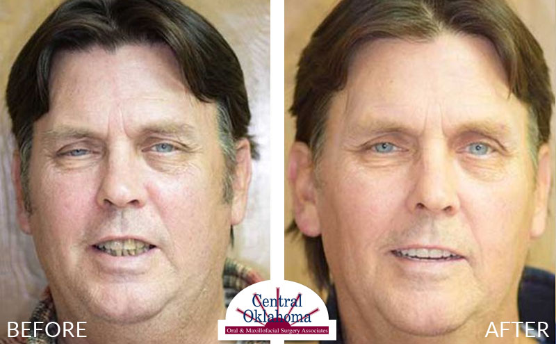 dental implants before and after | Oral Surgery Oklahoma City | Dr. Richard Miller | Central Oklahoma Oral & Maxillofacial Surgery Associates