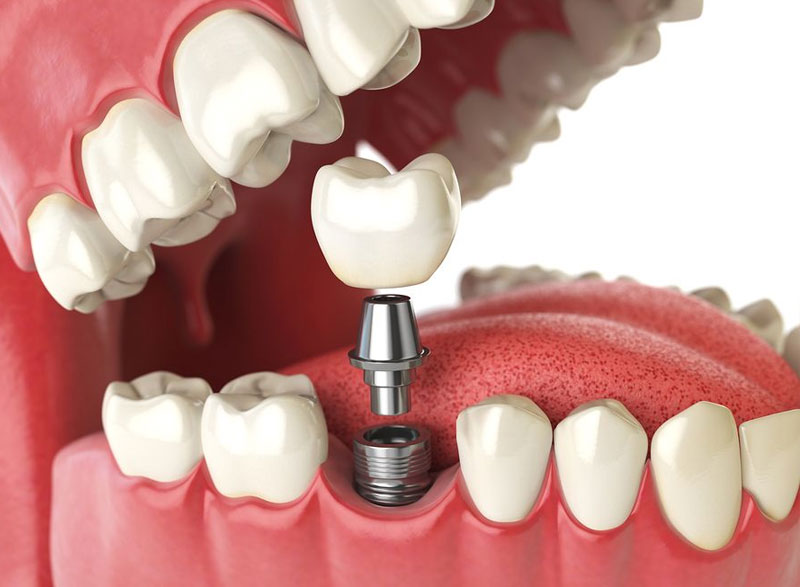 Dental implants | Oral Surgery Oklahoma | Dr. Richard Miller | Central Oklahoma Oral & Maxillofacial Surgery Associates