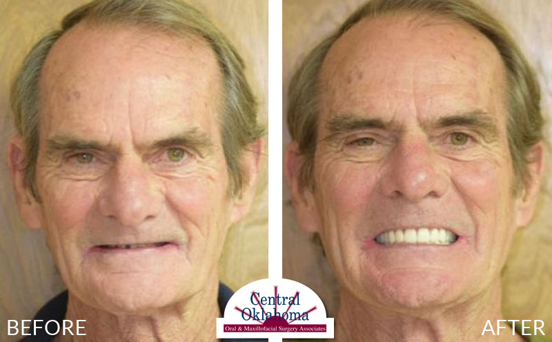 Oral Surgery before and after | Oral Surgery Stillwater | Dr. Richard Miller | Central Oklahoma Oral & Maxillofacial Surgery Associates