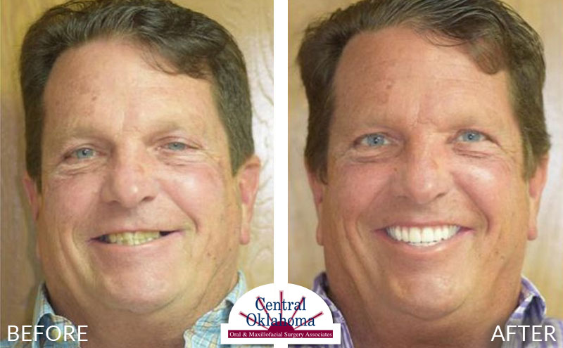 Oral Surgery before and after | Oral Surgery Tulsa | Dr. Richard Miller | Central Oklahoma Oral & Maxillofacial Surgery Associates