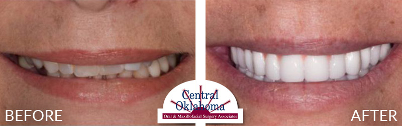 All-on-4 before and after | Oral Surgery Stillwater | Dr. Richard Miller | Central Oklahoma Oral & Maxillofacial Surgery Associates