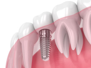 dental implants north Oklahoma