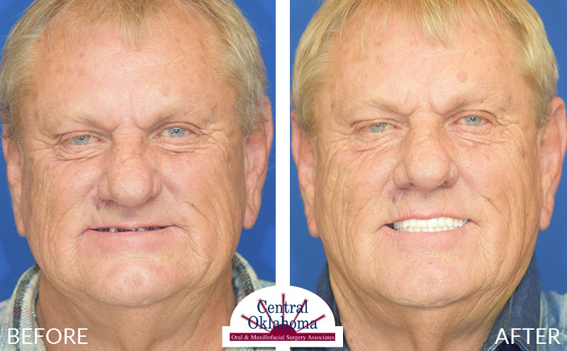 dental implants before and after | Oral Surgery Tulsa | Dr. Richard Miller | Central Oklahoma Oral & Maxillofacial Surgery Associates