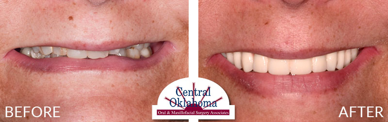 dental implants before and after | Oral Surgery Tulsa | Dr. Richard Miller | Central Oklahoma Oral & Maxillofacial Surgery Associates