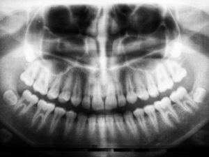 X-ray image of teeth