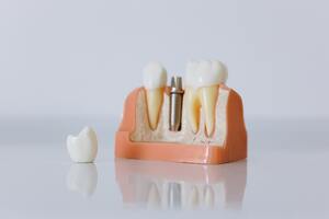 Photo by cottonbro: https://www.pexels.com/photo/close-up-shot-of-dental-implant-model-6502343/