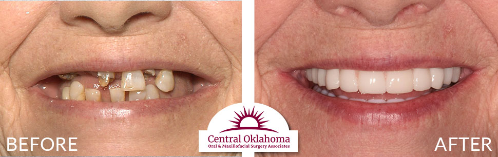 Oral Surgery before and after | Oral Surgery Oklahoma City | Dr. Richard Miller | Central Oklahoma Oral & Maxillofacial Surgery Associates