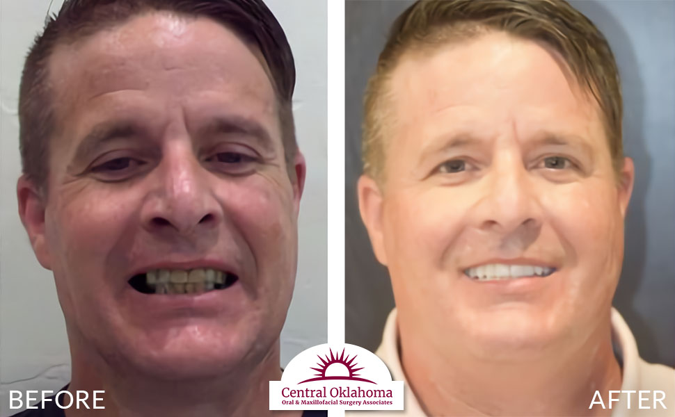Oral Surgery before and after | Oral Surgery Oklahoma City | Dr. Richard Miller | Central Oklahoma Oral & Maxillofacial Surgery Associates