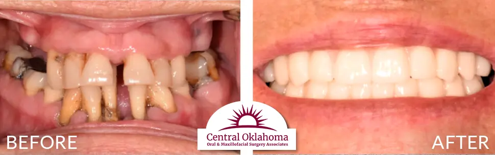 All on 4 implants | Oral Surgery Tulsa | Dr. Richard Miller | Central Oklahoma Oral & Maxillofacial Surgery Associates