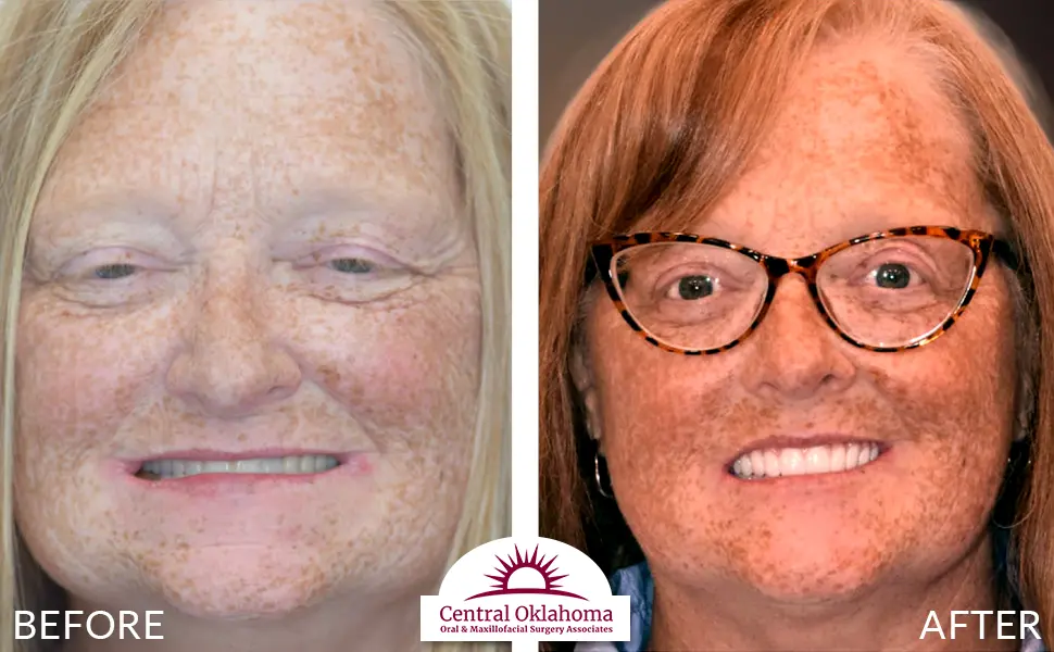 All on 4 implants | Oral Surgery Tulsa | Dr. Richard Miller | Central Oklahoma Oral & Maxillofacial Surgery Associates