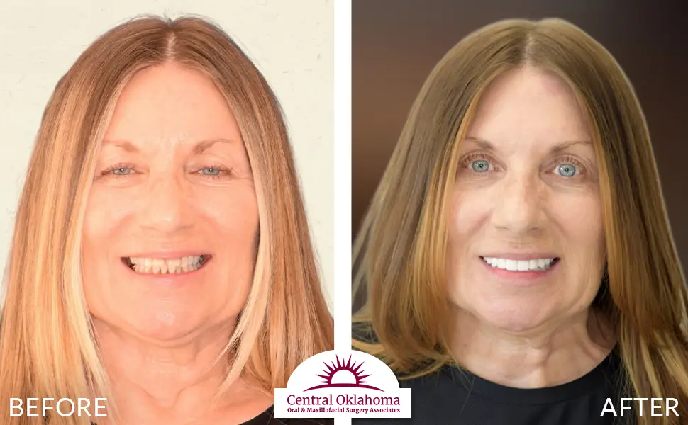 All on 4 implants | Oral Surgery Tulsa | Dr. Richard Miller | Central Oklahoma Oral & Maxillofacial Surgery Associates