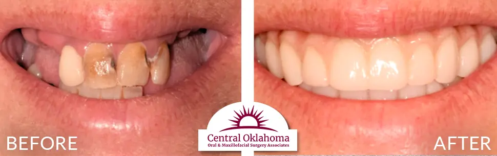 All on 4 implants | Oral Surgery Tulsa | Dr. Richard Miller | Central Oklahoma Oral & Maxillofacial Surgery Associates