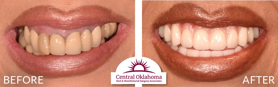 All on 4 implants | Oral Surgery Tulsa | Dr. Richard Miller | Central Oklahoma Oral & Maxillofacial Surgery Associates