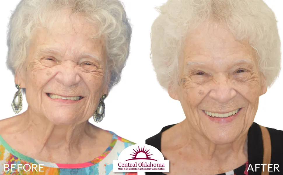 All on 4 implants | Oral Surgery Tulsa | Dr. Richard Miller | Central Oklahoma Oral & Maxillofacial Surgery Associates