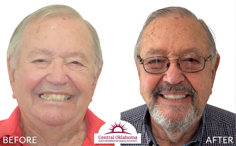 All on 4 implants | Oral Surgery Tulsa | Dr. Richard Miller | Central Oklahoma Oral & Maxillofacial Surgery Associates