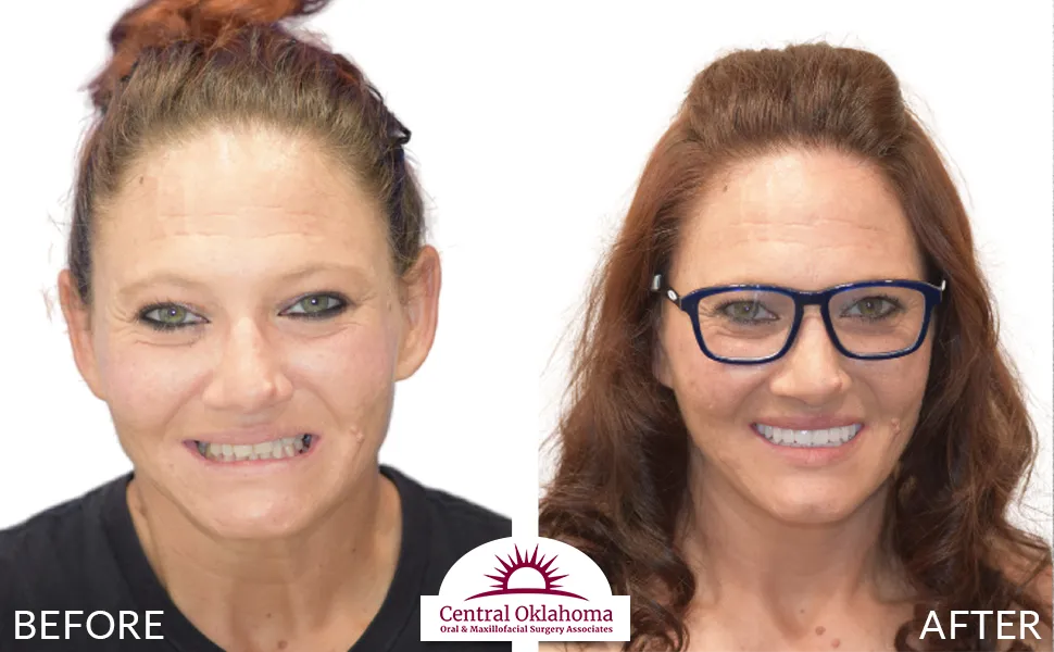 All on 4 implants | Oral Surgery Tulsa | Dr. Richard Miller | Central Oklahoma Oral & Maxillofacial Surgery Associates