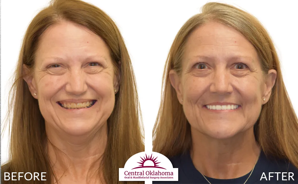 All on 4 implants | Oral Surgery Tulsa | Dr. Richard Miller | Central Oklahoma Oral & Maxillofacial Surgery Associates