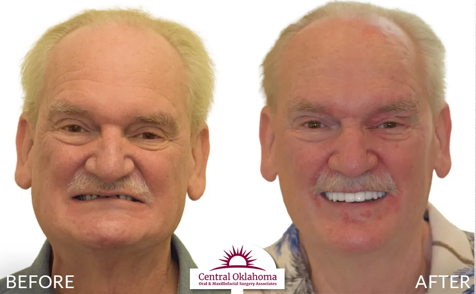 All on 4 implants | Oral Surgery Tulsa | Dr. Richard Miller | Central Oklahoma Oral & Maxillofacial Surgery Associates