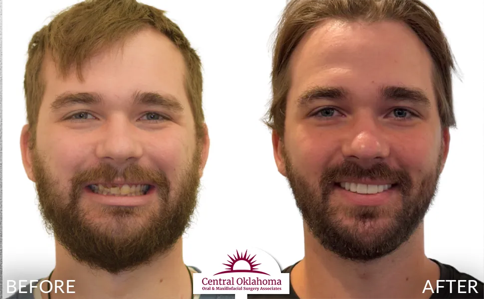All on 4 implants | Oral Surgery Tulsa | Dr. Richard Miller | Central Oklahoma Oral & Maxillofacial Surgery Associates