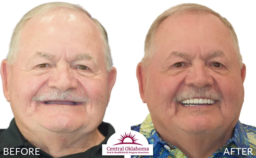 All on 4 implants | Oral Surgery Tulsa | Dr. Richard Miller | Central Oklahoma Oral & Maxillofacial Surgery Associates