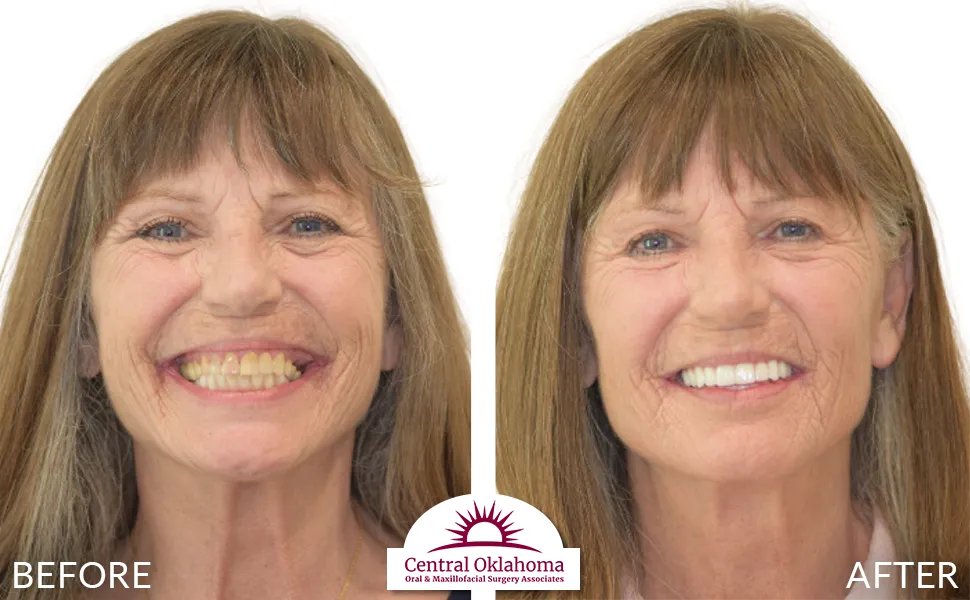 All on 4 implants | Oral Surgery Tulsa | Dr. Richard Miller | Central Oklahoma Oral & Maxillofacial Surgery Associates