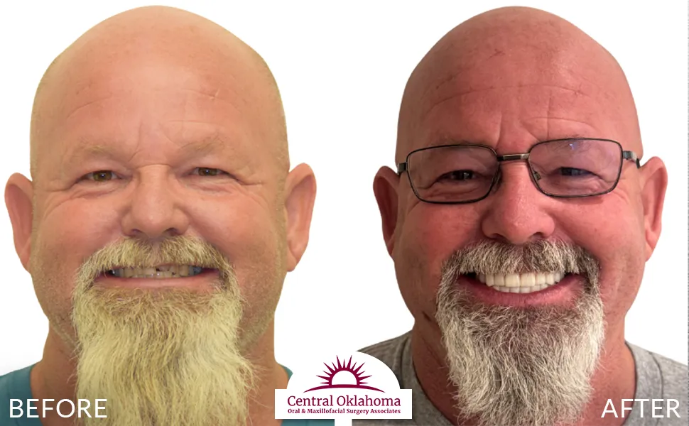 All on 4 implants | Oral Surgery Tulsa | Dr. Richard Miller | Central Oklahoma Oral & Maxillofacial Surgery Associates