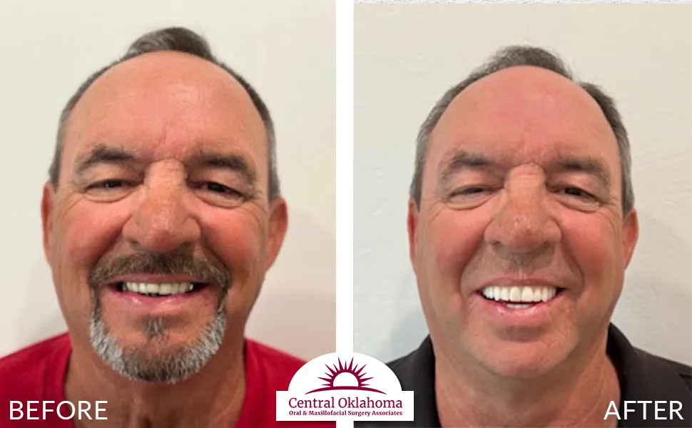 All on 4 implants | Oral Surgery Tulsa | Dr. Richard Miller | Central Oklahoma Oral & Maxillofacial Surgery Associates