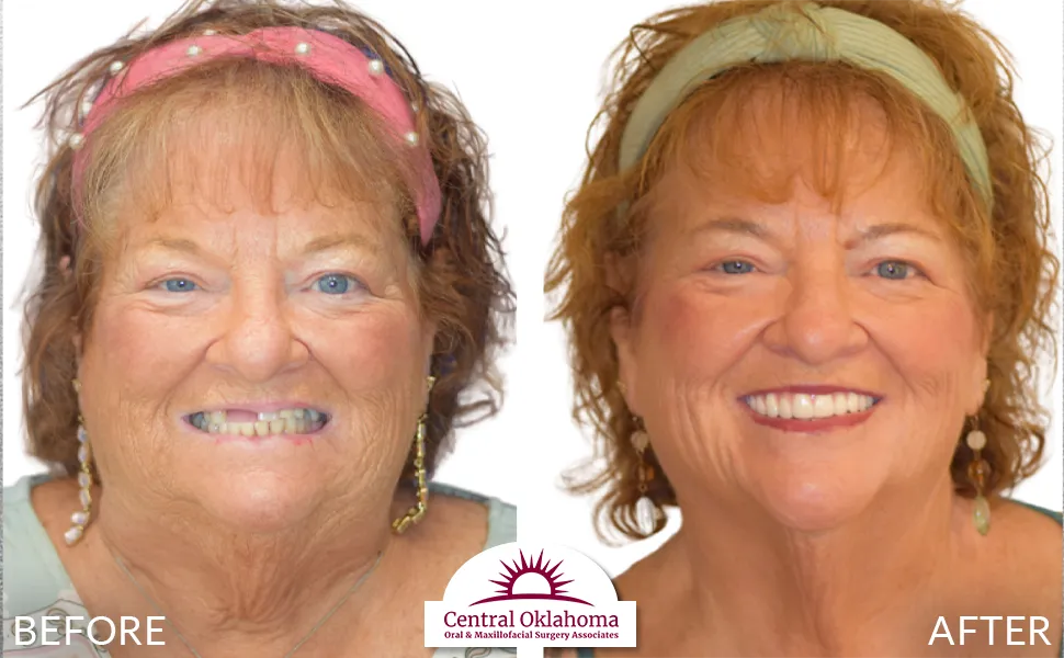 All on 4 implants | Oral Surgery Tulsa | Dr. Richard Miller | Central Oklahoma Oral & Maxillofacial Surgery Associates