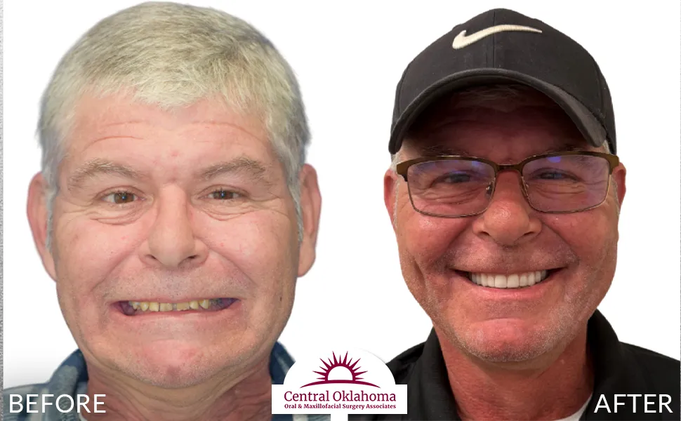 All on 4 implants | Oral Surgery Tulsa | Dr. Richard Miller | Central Oklahoma Oral & Maxillofacial Surgery Associates