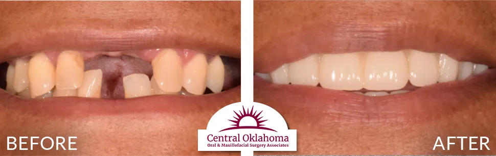 All on 4 implants | Oral Surgery Tulsa | Dr. Richard Miller | Central Oklahoma Oral & Maxillofacial Surgery Associates