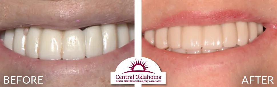 All on 4 implants | Oral Surgery Tulsa | Dr. Richard Miller | Central Oklahoma Oral & Maxillofacial Surgery Associates