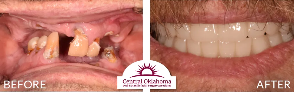 All on 4 implants | Oral Surgery Tulsa | Dr. Richard Miller | Central Oklahoma Oral & Maxillofacial Surgery Associates