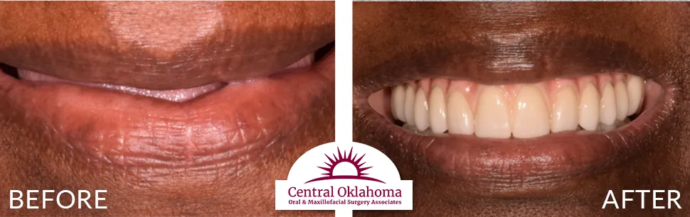 All on 4 implants | Oral Surgery Tulsa | Dr. Richard Miller | Central Oklahoma Oral & Maxillofacial Surgery Associates
