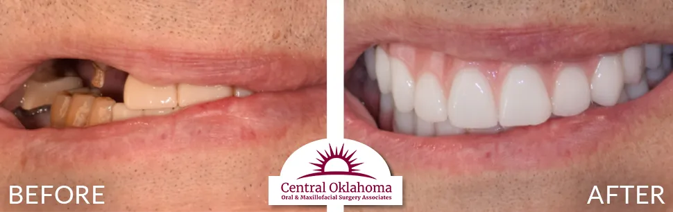 All on 4 implants | Oral Surgery Tulsa | Dr. Richard Miller | Central Oklahoma Oral & Maxillofacial Surgery Associates